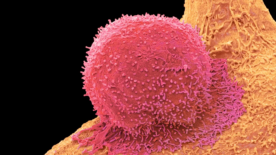 Colored scanning electron micrograph (SEM) of a T-cell ( red) and a breast cancer cell. STEVE GSCHMEISSNER/SCIENCE PHOTO LIBRARY