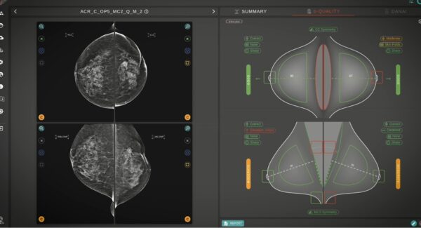 Mammografia studiata con l'assistenza dell'intelligenza artificiale. Humanitas